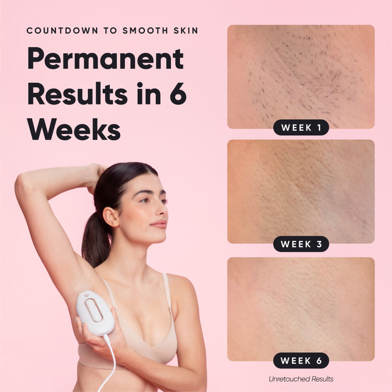 Lumi 2 - Permanent Hair Removal Device